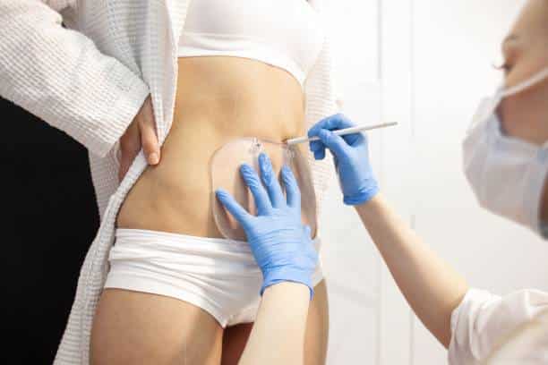 Cryolipolyse pour affiner silhouette sans chirurgie